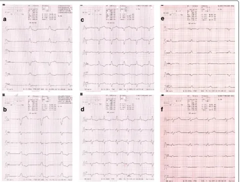 Figure 1 ECC recordings before CRT implantation showed a wide QRS due to LBBB (1 a-b); after CRT implantation simultaneousstimulation of the presumed RV electrode misplaced in the left ventricle and the CS electrode resulted in a narrow QRS and positiveR-w
