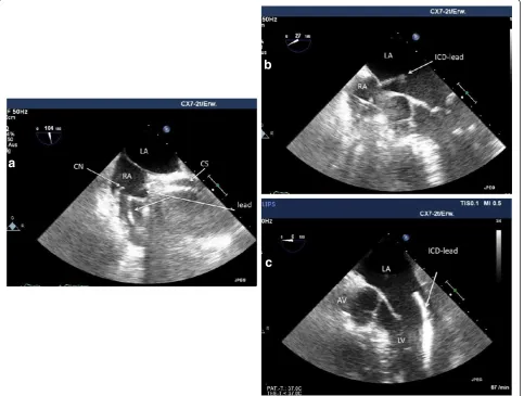 Figure 3 Transesophageal echocardiographic recordings after the original implantation procedure