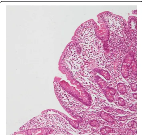Figure 1 Photomicrograph showing short and broad villi andlymphomononuclear cell infiltrate in lamina propria (H&E x 100).