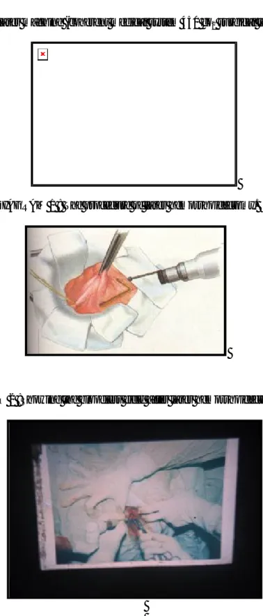 DIAGRAM 1 : The procedure of laser hemorrhoidectomy. 
