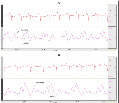 Table 2 Hemodynamic variables before and during mechanical support by the IABP or ETPACD in acute heart failure