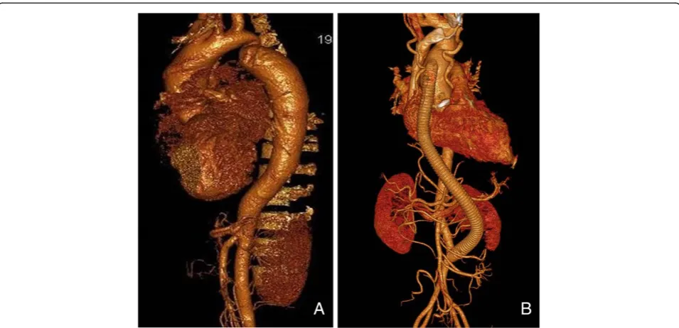 Fig. 2 The aorta-lower abdomiml aorta bypass graft procedure. End-to-side graft-to-distal abdominal aorta anastomosis and end-to-side graft-toascending aorta anastomosis is performed (a, c)