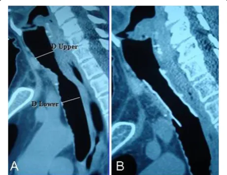 Figure 1 A Follow up MDCT of a patient diagnosed as a squamous cell lung cancer. B MDCT of a patient with alveolus stent in the rightmain and the intermediate bronchi