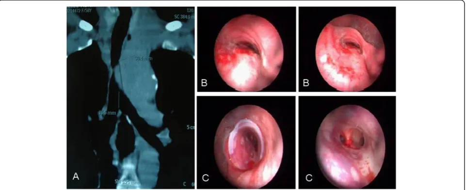 Figure 3 A MDCT revealed a mediastinal mass compressing the trachea. BIn Figure 3C it has shown as the patient's condition improved dramatically after the treatment of endobronchial stenosis