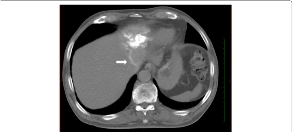 Figure 2 A case of AML with early venous return. CT angiography via the left hepatic artery showed a patchy enhanced tumor in S3 with earlyvenous return to left hepatic vein (arrow).