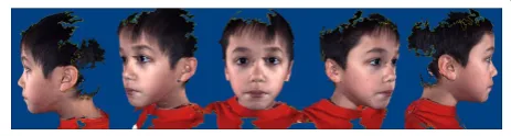 Figure 2 3dMD image acquisition and analysis. (A) Example of a3dMD image acquired from an individual chosen at random fromthe study sample.