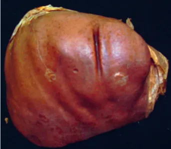 Figure 2. Type 2 costal liver with very small left lobe and deep  impressions.