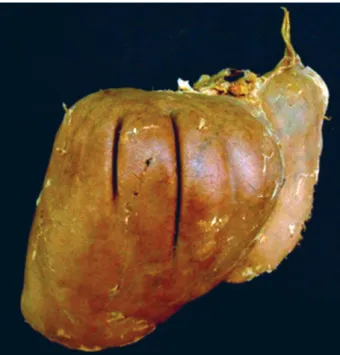 Figure 6. Type 8 liver with right lobe very much smaller than  the left.