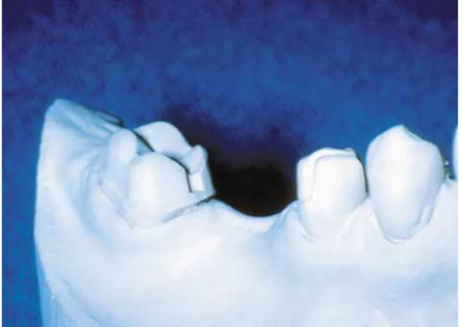 Fig. 8. Cast of mandibular molar retainer tooth preparation incorporating mesial box to increase resistance form.
