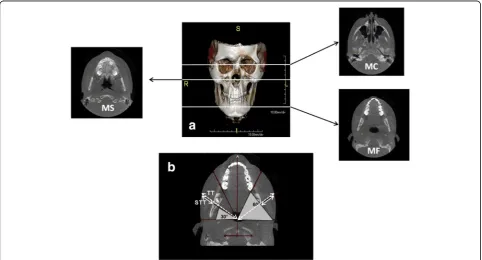 Fig. 1 a 3D–Cone Beam Computed Tomography (CBCT) showing the levels of the three transverse sections (mandibular condyle, MC, maxillarysinus MS, mandibular foramen MF) selected for the comparison of affected and unaffected side