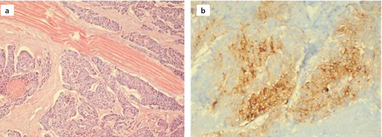 Fig. 4. The tumor cells with hyperchromatic nucleus and eosinophilic cytoplasm, which forms gland structures, and thereby creating lumen fiber forma- forma-tions and showing invasions between muscle (H&amp;E, x100) (a)