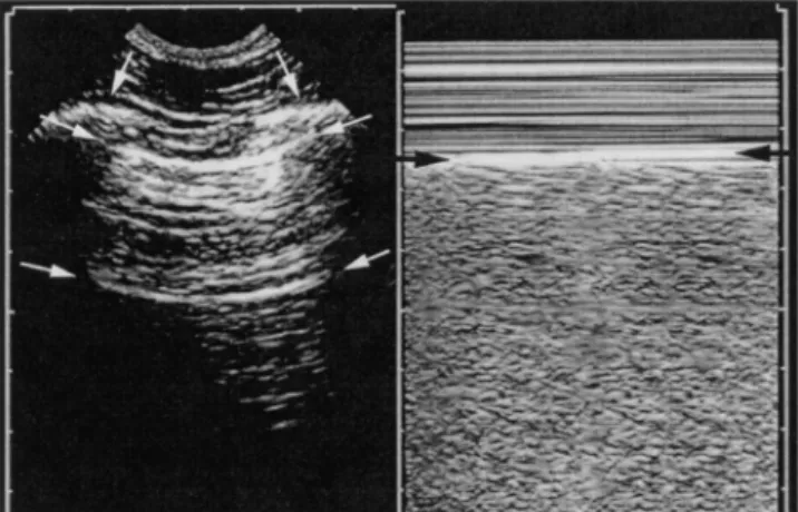 graphic exploration of the posterior lung fields (zone 3). As the probe is required to