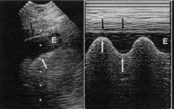 Figure 3. Pleural effusion in an intercostal ap- ap-proach. Note one basic static sign, the sharp sign, as the effusion (E) is outlined by four regular borders: pleural line, shadow of ribs, visceral pleura