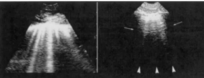 Figure 7. Some artifacts: E and Z lines. Left, these well-defined comet tails descend to the edge of the screen