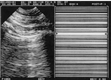 Figure 8. Pneumothorax and stratosphere sign. The complete abolition of lung sliding can be objectified using M mode (right)