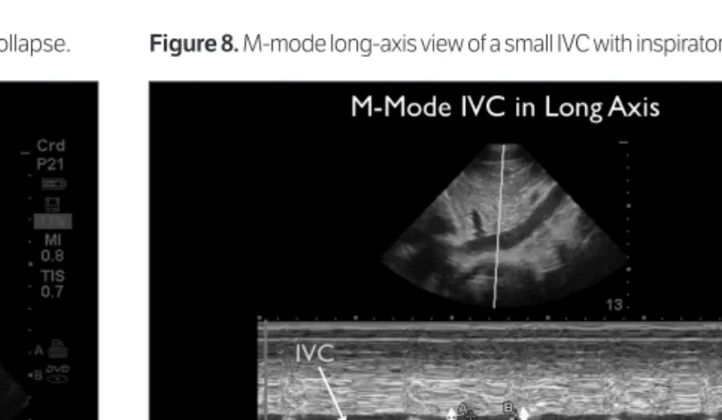 Figure 8. M-mode long-axis view of a small IVC with inspiratory collapse.