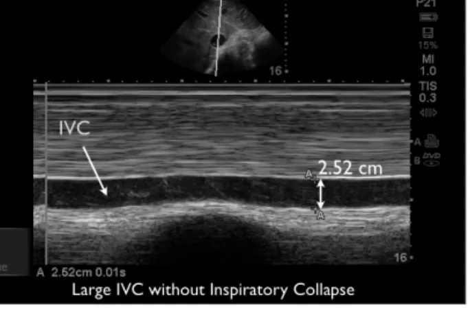 Figure 10.M-mode long-axis view of a large IVC without inspiratory collapse.