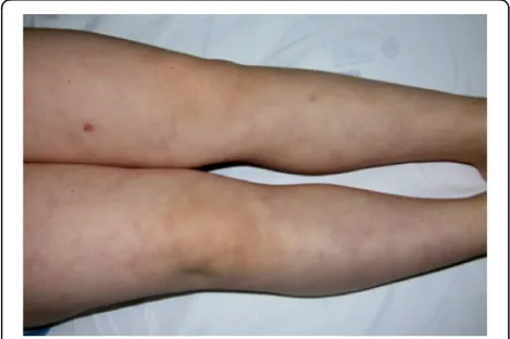 Fig. 3 Livedo reticularis in a patient with DADA2