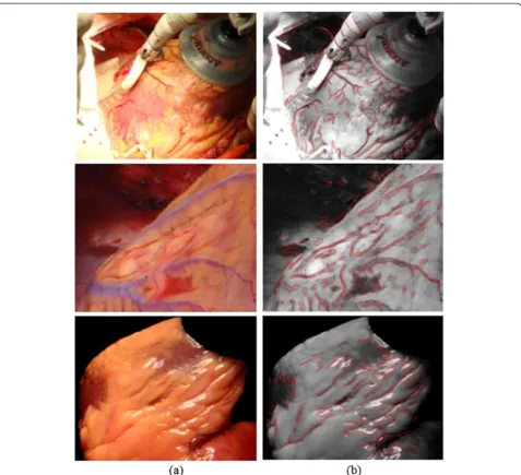 Figure 12 Human heart vessel segmentation result using ARIA algorithm [30]. (a) Original human heart images