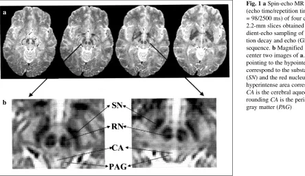 Fig. 1 a Spin-echo MR images (echo time/repetition time (TE/TR)= 98/2500 ms) of four contiguous2.2-mm slices obtained with the gra-dient-echo sampling of free induc-tion decay and echo (GESFIDE)sequence