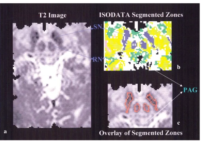 Fig. 2 a Spin-echo T2-weighted imagefrom each echo of the GESFIDE pulsesequence were used in the computercluster analysis (ISODATA) to segmentbrain tissue