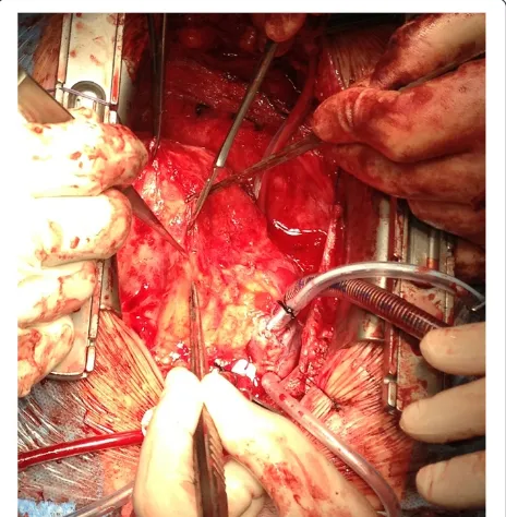 Figure 1 Surgical approach to the VSD via right ventriculotomy.