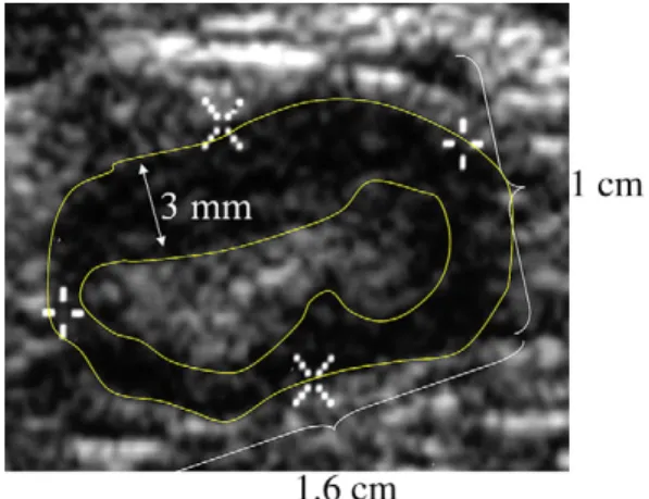 Fig. 8. Malignant axillary lymph node. A small lymph node (long axis <2 cm, short axis >1 cm) with an  asym-metrically thickened (>3 mm) cortex with hilar compression (although no hilar displacement)