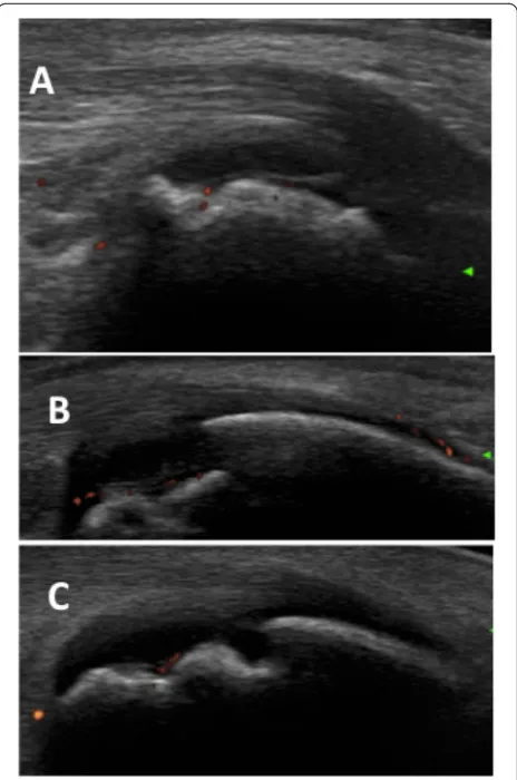 Fig. 7 The calcaneus bone appears fragmented in childrenvessels can be detected by power Doppler (respectively aged 6 years (a), 8 years (b), and 10 years (c)