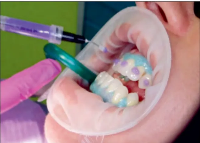 Figure 6. Activation of the peroxide gel with the  bleaching piece light by Epic Biolase laser
