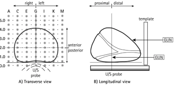 Figure 1: Method used for transperineal template prostate mapping biopsies. 