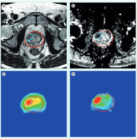 Figure 1. Dose painting in the FLAME trial based on T 2 -weighted MRI (A), an apparent  diffusion coefficient map, obtained from diffusion-weighted MRI (B), and a K trans  parameter  map derived from dynamic contrast-enhanced MRI (C), with dose distributio