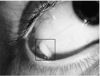 Figure 2 Ocular insert 