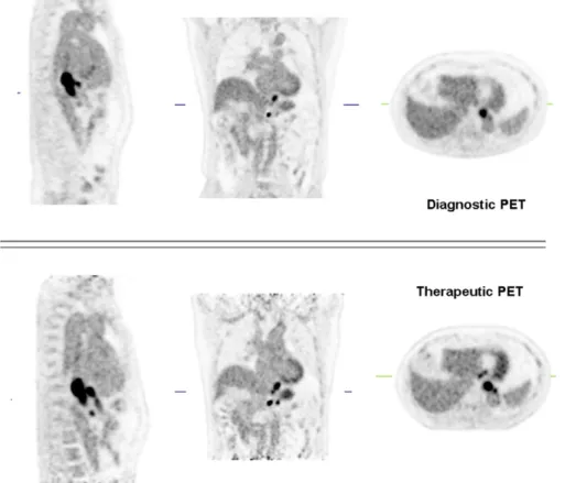 Fig. 1. Lymph node progression was found within an interval of 31 days between the diagnostic and therapeutic PET scans, which were both performed on the integrated PET/CT scanner.