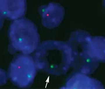 Figure  5.  Over-digested  (8-minute  enzymatic  digestion)  FFPE  breast  tissue  stained with gene probe (red), a centromere reference PNA probe (green) and  DAPI  (blue)