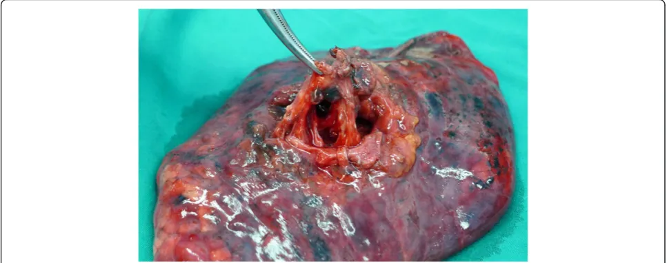 Figure 1 Right upper lobe.