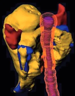 Figure 8. Left posterior view of a head and neck cancer treated with IMRT. The 54 Gy  isodose (dark yellow) is partly covering the planning target volume (PTV) (blue)