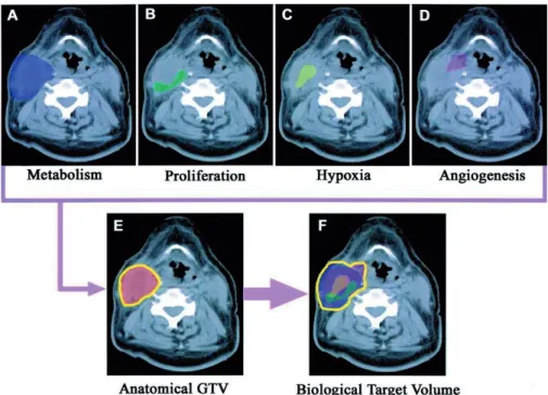 Figure 9. Imaging paradigm in radiation oncology integrating different functional  imaging modalities (panel A-D) with CT defined GTV (panel E) to obtain a combined  BTV (panel F)