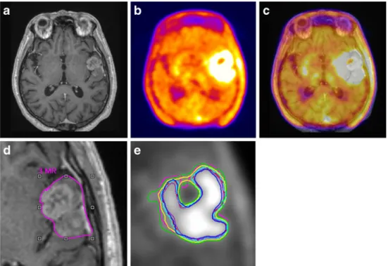 Fig. 6 Gadolinium-enhanced T1-weighted MRI (a),