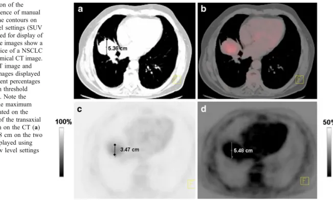 Fig. 2 Optimal percentage maximum SUV threshold selection in NSCLC. Reprinted with permission from [82]