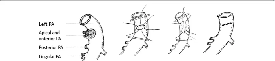 Figure 1 Tangential arterial resection with direct sutures. A. Left upper lobectomy. Left apical, anterior and lingular arteries were invaded