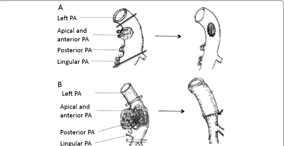 Figure 4 Only preserved the truncus anterior (both anterior and apical pulmonary artery branches) for bilobectomy (Right middle &lower lobectomy).