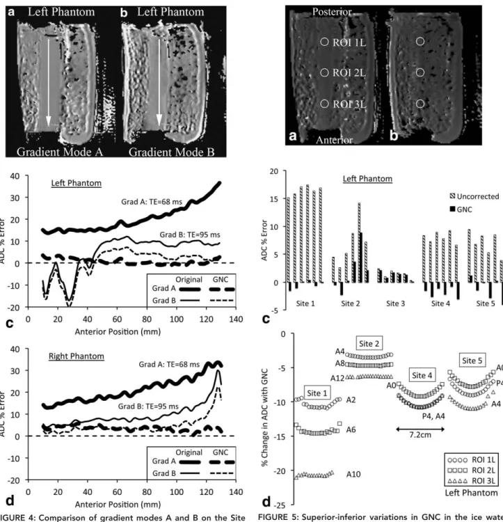 FIGURE 4: Comparison of gradient modes A and B on the Site 1 scanner. (a,b) Left phantom GNC ADC maps for the two  gra-dient modes