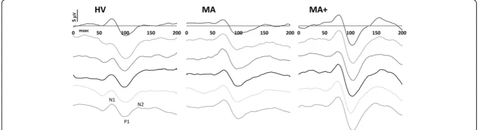 Fig. 1 Representative recordings (low pass filter 35 Hz) of visual evoked potentials in a healthy volunteer (HV), a migraine patient with pure visual aura(MA), and a migraine patient with complex aura (MA+) recorded between attacks
