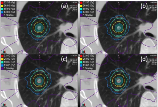 Figure 1 shows a comparison of isodose lines from the four different calculation methods for a  small lung lesion surrounded by lung tissue (Patient 6)