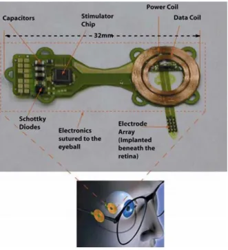 Figure 1.18. Schematic representation of the minimally invasive ab-externo approach. The 