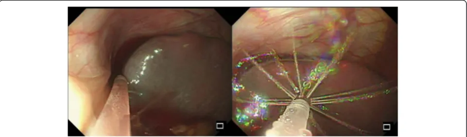 Fig. 4 Use of flexible irrigation/suction catheter (Endoshower) for diffuse intra-abdominal irrigation using sterile saline solution, and atraumaticsuction of the fluid in the left sub-diaphragmatic space under direct endoscopic vision