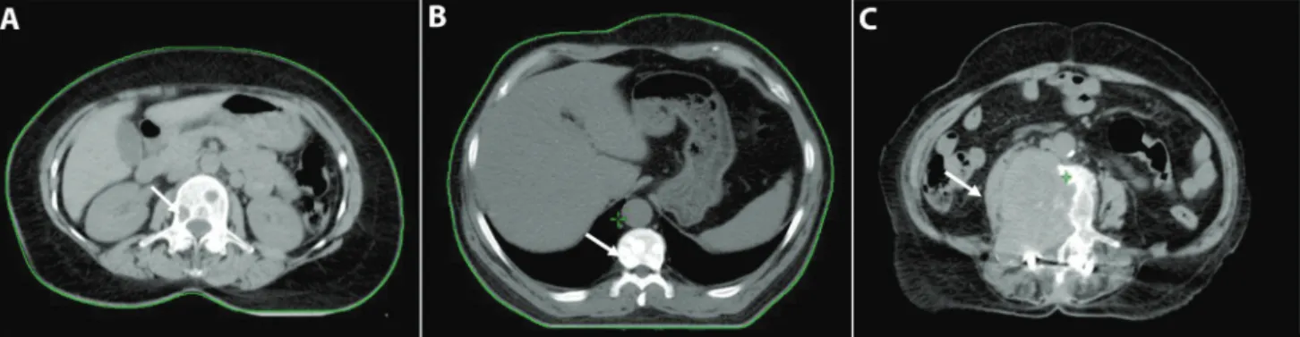 Figure 1 - Types of bone metastasis (white arrows). A) Osteolytic metastasis. B) Osteoblastic metastasis