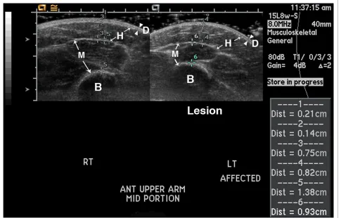 Figure 1 14 year old girl with linear scleroderma affecting her left arm; portion shown is from her upper arm