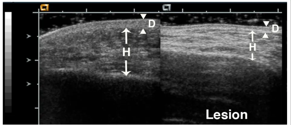 Figure 2 17 year old girl with generalized morphea that began over 13 years earlierlesions show dyspigmentation and mild tissue loss, but her back lesions have increased warmth