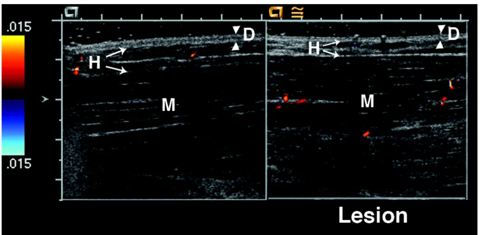 Figure 4 15 year old girl with linear scleroderma of her left leg that has progressed over the past three years